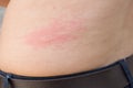 A woman is urticaria on back