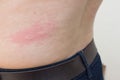 A woman is urticaria on back