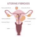 Woman uterine fibroids diagram on white background