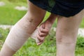 Woman with varicose veins applying compression bandage Royalty Free Stock Photo