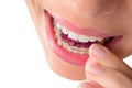 Woman wearing orthodontic removable brac