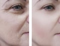Woman wrinkles beautician on face patient before and after lifting cosmetic procedures Royalty Free Stock Photo