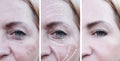 Woman wrinkles effect correction treatment difference before and after procedures, arrow, pigmentation Royalty Free Stock Photo