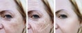 Woman wrinkles correction treatment difference before and after procedures, arrow, pigmentation Royalty Free Stock Photo