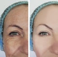 Woman wrinkles before and after cosmetology therapy, ageing procedure biorevitalization treatments Royalty Free Stock Photo