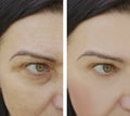 Woman difference wrinkles beautician health pigmentation face patient before and after lifting cosmetic procedures contrast Royalty Free Stock Photo