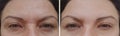 Woman difference wrinkles beautician age mature patient before and after lifting cosmetic procedures contrast