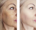 Woman wrinkles before and after effect correction ifting procedure removal Royalty Free Stock Photo