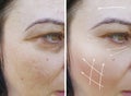 Woman wrinkles effect correction before and after treatment rejuvenation procedures lifting, therapy Royalty Free Stock Photo