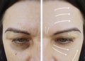 Woman wrinkles effect before and after treatment rejuvenation procedures lifting, therapy Royalty Free Stock Photo