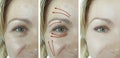 Woman wrinkles eye beautician contrast procedure   concept result before and after rejuvenation arrow Royalty Free Stock Photo