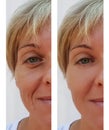 Woman wrinkles on face dermatology treatment correction surgeon before and after health anti-aging procedures Royalty Free Stock Photo