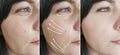 Woman wrinkles face arrow collage lifting tension before and after contrast treatment Royalty Free Stock Photo