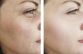 Woman wrinkles face beautician effect therapydifference regeneration before and after treatments