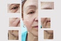 Woman wrinkles face before after collagen surgery patient lifting surgery treatment correction crease therapy g Royalty Free Stock Photo