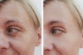 Woman wrinkles on face concept before and after patient injection anti-aging procedures Royalty Free Stock Photo