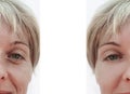 Woman wrinkles on face, contrast before and after procedures collage