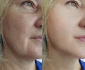 Woman wrinkles face before correction collage   tightening removal after treatment, double chin Royalty Free Stock Photo