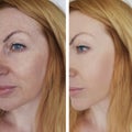 Woman wrinkles face before and after correction cosmetic procedures Royalty Free Stock Photo