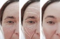 Woman wrinkles face rosacea before and after difference cosmetology therapy correction, arrow Royalty Free Stock Photo