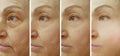 Woman wrinkles face before and after results lifting difference tension therapy correction Royalty Free Stock Photo