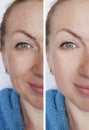 Woman wrinkles face before and after therapy removal cosmetic procedures difference Royalty Free Stock Photo