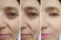 Woman wrinkles face before  after cosmetology effect plastic therapy procedure treatment arrow thread lifting, Royalty Free Stock Photo