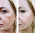 Woman wrinkles face crease pigmentation difference before and after procedures effect