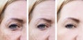 Woman wrinkles face crease pigmentation therapy difference before and after procedures effect