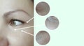 Woman wrinkles face eye   problem rejuvenation aging removal puffiness lifting before and after collage treatment Royalty Free Stock Photo