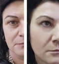 Woman wrinkles face before and after lifting correction cosmetic procedures Royalty Free Stock Photo
