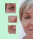 Woman wrinkles on face before and after patient injection anti-aging procedures Royalty Free Stock Photo