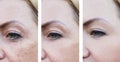 Woman wrinkles on face, pigmentation removal dermatology before and after procedures Royalty Free Stock Photo