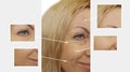 Woman wrinkles face before after collagen surgery patient lifting surgery treatment correction crease lift therapy g Royalty Free Stock Photo