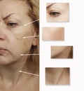 Woman wrinkles face before and after procedures lifting surgery treatment correction crease lifting Royalty Free Stock Photo