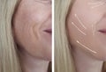 Woman wrinkles face treatment before and after correction dermatology procedures regeneration Royalty Free Stock Photo