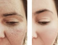 Woman wrinkles face before and after procedures dermatology