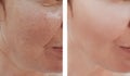 Woman wrinkles face before and after correction procedures dermatology