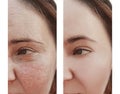 Woman wrinkles face before and after difference rejuvenation correction procedures dermatology Royalty Free Stock Photo