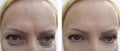 Woman wrinkles regeneration removal biorevitalization patient difference effect face before and after procedures