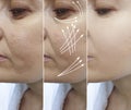 Woman wrinkles face after rejuvenation effect plastic therapy procedure treatment arrow thread lifting, Royalty Free Stock Photo