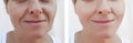 Woman wrinkles face removal difference patient before and after treatments dermatology Royalty Free Stock Photo