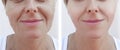 Woman wrinkles face removal before and after treatments cosmetology Royalty Free Stock Photo
