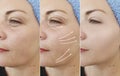 Woman wrinkles face results  arrow  collage  lifting  contour tension  before and after contrast treatment Royalty Free Stock Photo