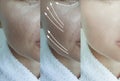 Woman wrinkles face skin after effect plastic therapy procedure treatment arrow thread lifting, Royalty Free Stock Photo