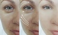 Woman wrinkles face skin after regeneration effect health plastic therapy procedure treatment arrow thread lifting, Royalty Free Stock Photo