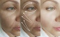 Woman wrinkles face skin after effect health plastic therapy procedure treatment arrow thread lifting, Royalty Free Stock Photo