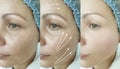 Woman wrinkles face skin after regeneration plastic therapy procedure treatment arrow thread lifting, Royalty Free Stock Photo