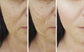 Woman wrinkles skin face lift rejuvenation difference cosmetology before and after treatments Royalty Free Stock Photo