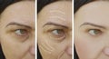 Woman wrinkles skin face lift rejuvenation therapy difference cosmetology before and after treatments Royalty Free Stock Photo